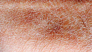 Acerca de la piel, emolienta, xerosis piel seca